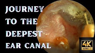 Otomycosis  A Journey to The End of Ear Canal [upl. by Agnes915]