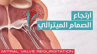 Mitral Valve Regurgitation 💖 ارتجاع الصمام الميترالي [upl. by Kayley155]