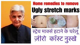 How to remove stretch markshome remedy to cure stretch marksस्ट्रेच मार्क्स हटाने के घरेलू नुस्खे [upl. by Hevak491]