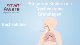 Pflege von Kindern mit Tracheostoma Tracheotomie  Pflegestandards Kinderkrankenpflege  smartAware [upl. by Philbin]