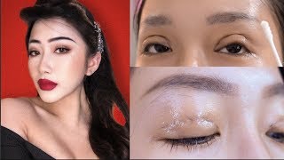 MY SCARLESS DOUBLE EYELID STITCHING SURGERY RECOVERY [upl. by Naujud253]