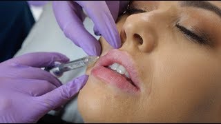 Lip Fillers  what to expect during the procedure  The Laser amp Skin Clinic [upl. by Dixil]