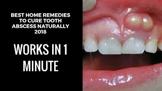 how to drain a tooth abscess at home home remedies for tooth abscesstooth abscess pain relief fast [upl. by Ilka]