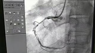 Angioplasty of total cut off RCA [upl. by Occir]