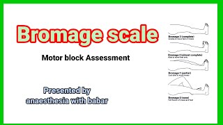 Bromage scale  motor block Assessment anaesthesiawithbabar2576 short [upl. by Nyvlem]