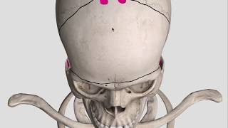 Bifrontal decompressive craniectomy bony cuts [upl. by Aikenahs]