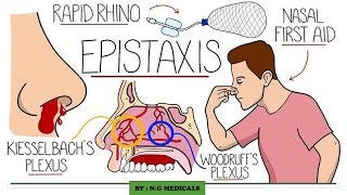 Epistaxis  Nose bleeding NGMedicals [upl. by Dailey398]