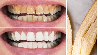 Whitening Teeth Home Remedies To remove Stains and Get White Teeth Overnight [upl. by Battat]