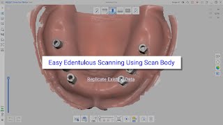 Easy Edentulous Scanning Using Scan Body Replicate Existing Data [upl. by Samuelson470]