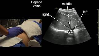 Transverse Liver Scan Technique [upl. by Ttoille]