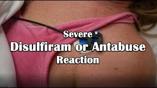 Disulfiram or Antabuse Reaction Emergency [upl. by Darum]