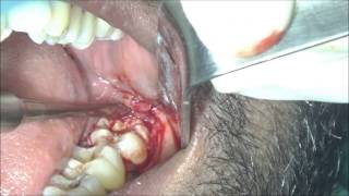 Chronic pericoronitis disioangular wisdom teeth removal video [upl. by Sanjiv]