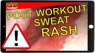 How To Treat Sweat Rash [upl. by Jami]