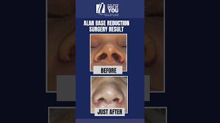 BeforeAfter Result Alar Base Reduction Surgery  Fix wide nostrils with Rhinoplasty  Dr PK Talwar [upl. by Pollie818]