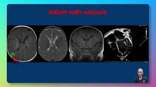 Tuberous Sclerosis [upl. by Hafler101]