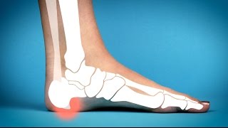 Two aids for heel spurs [upl. by Amasa]