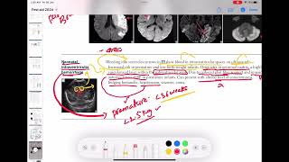 Neonatal intraventricular hemorrhage neurology 79  First Aid USMLE Step 1 in UrduHindi [upl. by Haeluj547]