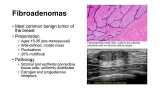 Fibroadenomas and Phyllodes Tumors [upl. by Arriec]