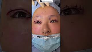 Fixing Epicanthic Fold  Double Eyelid Surgery with Dr Kenneth Kim  Transformation Journey [upl. by Rhys]