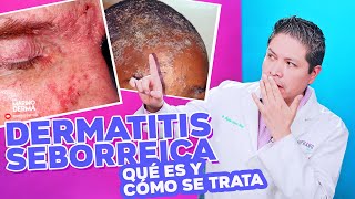 DERMATITIS SEBORREICA ¿QUE ES Y COMO SE TRATA Tips de un dermatologo [upl. by Menendez579]