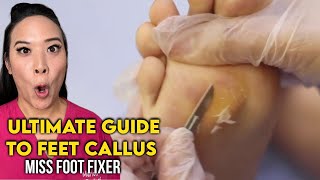 Ultimate Guide to Feet Callus  Causes Prevention amp Treatment By Famous Podiatrist Miss Foot Fixer [upl. by Adnahcir]