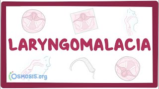 Laryngomalacia  an Osmosis Preview [upl. by Sairu]