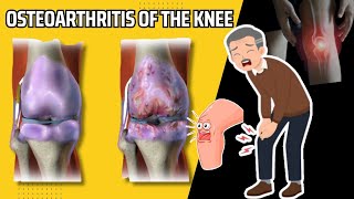 The Complete Guide to Osteoarthritis Symptoms Causes and Treatments for Knee Joints Notes [upl. by Aidahs]