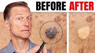 How to Remove Skin Tags and Warts Overnight  Dr Berg Explains [upl. by Nahtanaj]