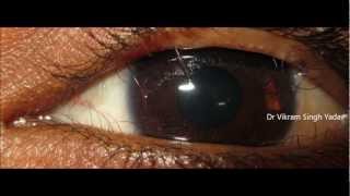 What Is Trichiasis [upl. by Annayrb]