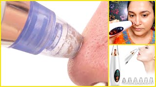 1 min blackheads amp whiteheads remove method OMG IT WORKED suction blackhead remover Review amp Demo [upl. by Anitrebla]