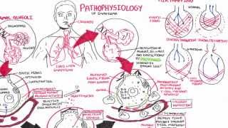 Emphysema  Pathophysiology COPD [upl. by Alyson]