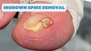 Ingrown SPIKE Removal FAILED SURGERY [upl. by Schlesinger]