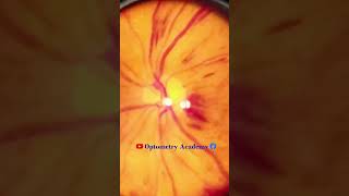 Diabetic retinopathy  Hemorrhages  proliferative diabetic retinopathy PDR  Short Video 184 [upl. by Onateyac725]