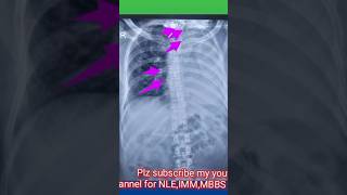 4 signs of lung collapse on chest xray  4 causes of lung collapse on chest xraychestxraymbbs [upl. by Nerej]