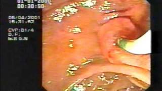 Endoscopy Master Videos ERCP Cannulation amp sphincterotomy  wwwgastrolivercomsg [upl. by Akkimat762]