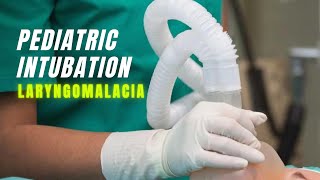 Pediatric Intubation  With Laryngomalacia [upl. by Sethi899]