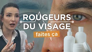 ROUGEURS autour des sourcils du nez Voila comment SOIGNER la dermite seborrhéique [upl. by Annuaerb]