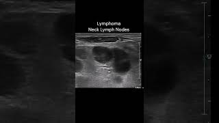 Neck Lymph Nodes  3 ultrasound imaging cases lymphoma [upl. by Filemon]