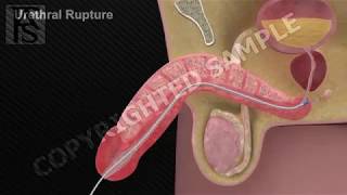 Urethral Rupture [upl. by Notsniw426]