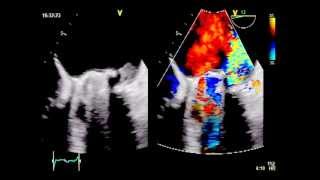 ROCKING MOTION  Major dehiscence of infected mitral valve prosthesis [upl. by Rempe]