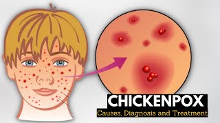 Chickenpox Causes Signs and Symptoms Diagnosis and Treatment [upl. by Dallis]