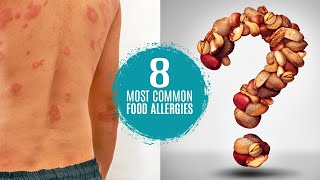 What are the 8 Most Common Food Allergies Symptoms Treatment amp Testing [upl. by Aicinod288]