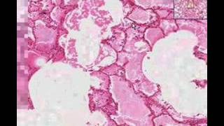 Histopathology Lung Acute pulmonary edema Asbestos bodies [upl. by Keely127]