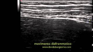 movimento diaframmatico  DIAFRAGMATIC MOVEMENT FUSAE APPROACH [upl. by Turrell982]