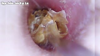 Ear Wax Removal 173 Thick and hard earwax causes ear pain and itching  Ear Cleaning ASMR [upl. by Akemyt]