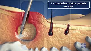 EPSIT Endoscopic Pilonidal Sinus Treatment  Tratamento Endoscópico do Cisto Pilonidal [upl. by Pazia]