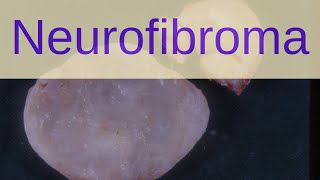 What is a Neurofibroma  Pathology mini tutorials [upl. by Gambrill]