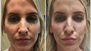 UNDER EYE FILLER VLOG  Before amp After [upl. by Nealson871]