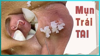 Big Cystic Acne Blackheads Extraction Blackheads amp Milia Whiteheads Removal Pimple Popping [upl. by Thar]