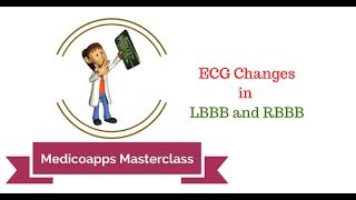 ECG Changes in LBBB and RBBB [upl. by Karissa20]